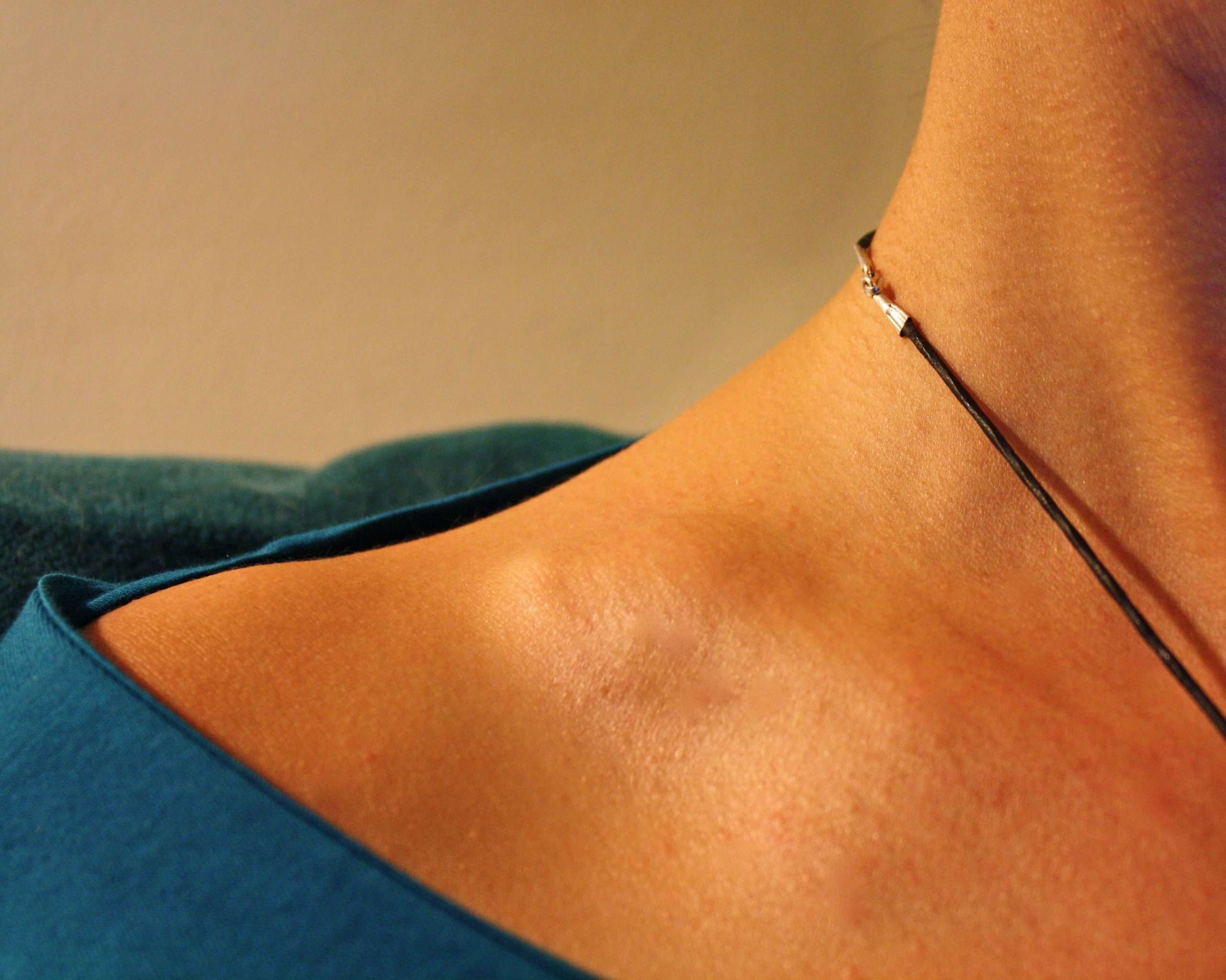 What to do if you have whiplash after a not at fault accident